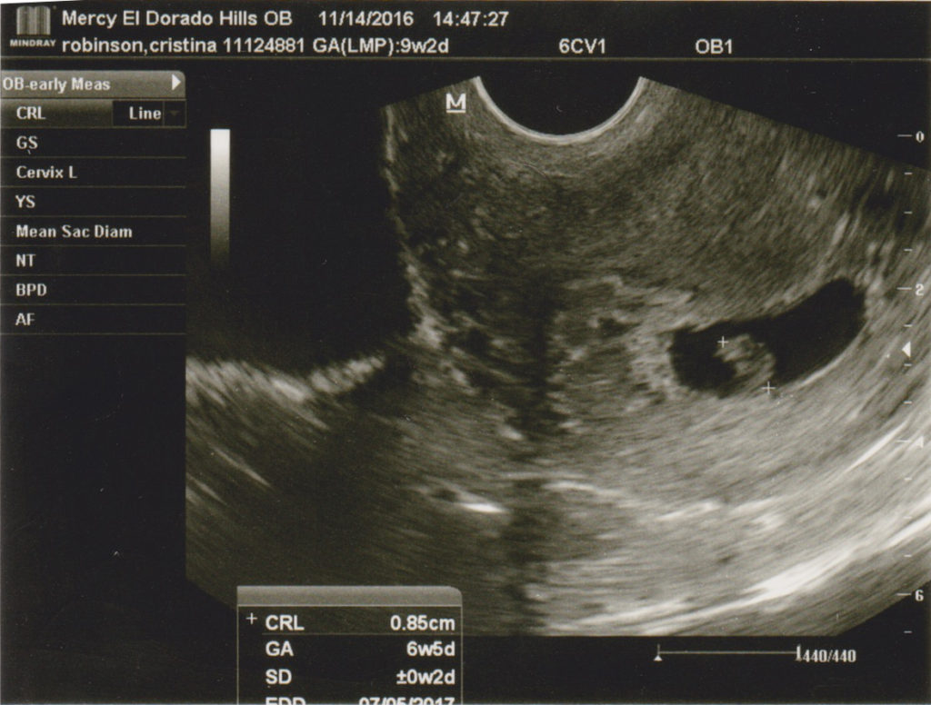 1st ultrasound at 6 weeks 5 days