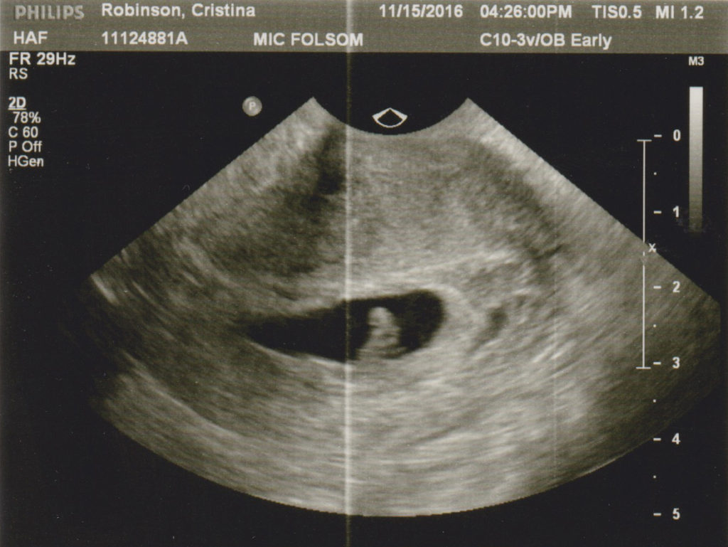 2nd ultrasound
