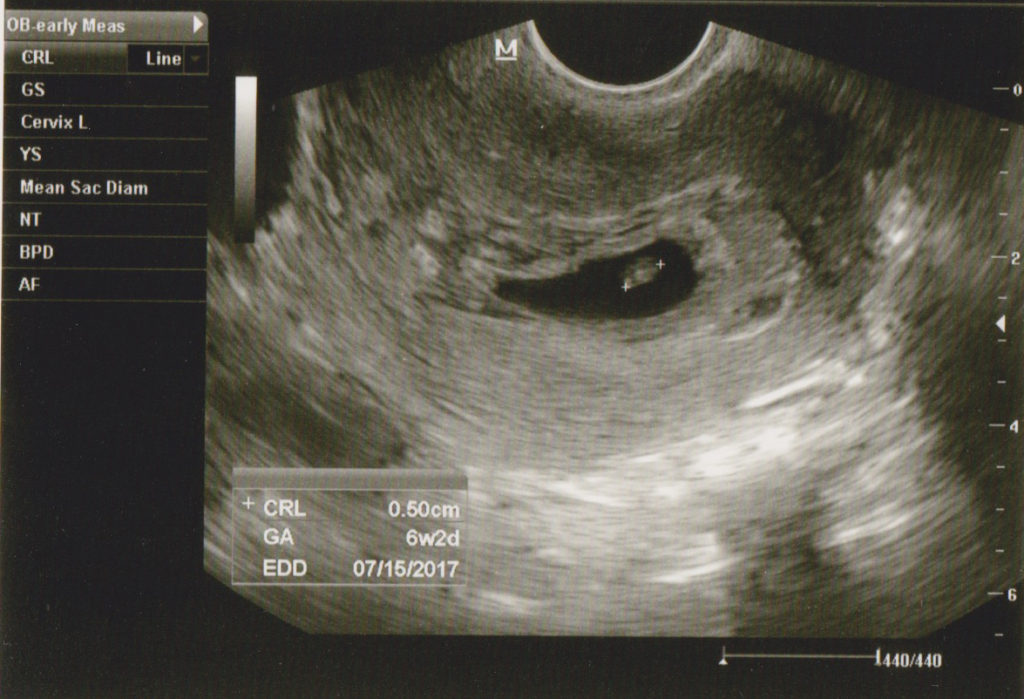 3rd ultrasound showing the baby stopped growing