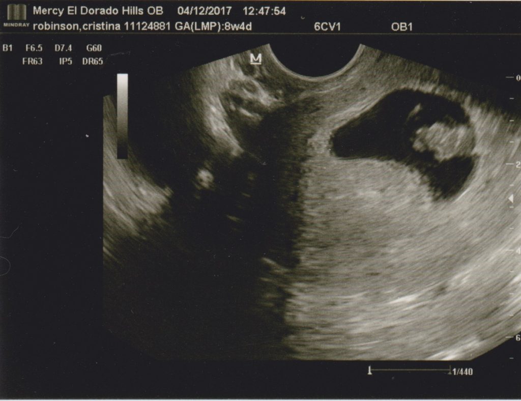 Our first ultrasound at 8 weeks + 4 days